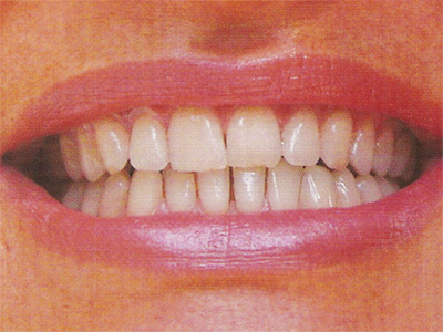 Belles dents 