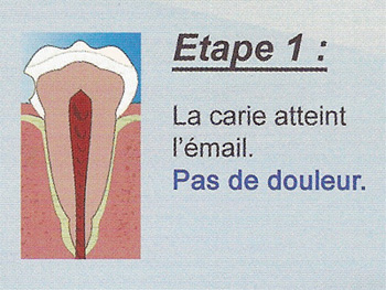 Carie étape 1 