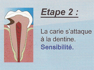 Carie étape 2 