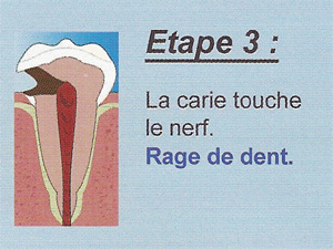 Carie étape 3 