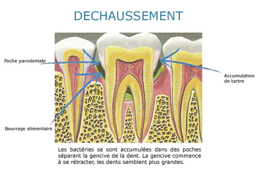 déchaussement 