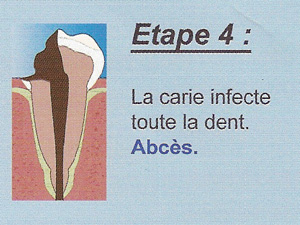 Carie étape 4 