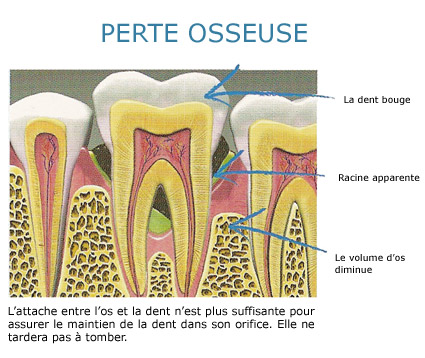 perte osseuse 