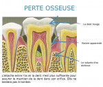 perte osseuse - 