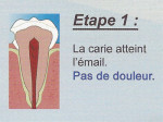 Carie étape 1 - 